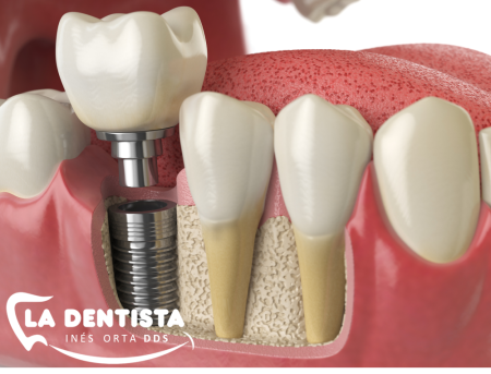 Single Tooth Implant Hialeah